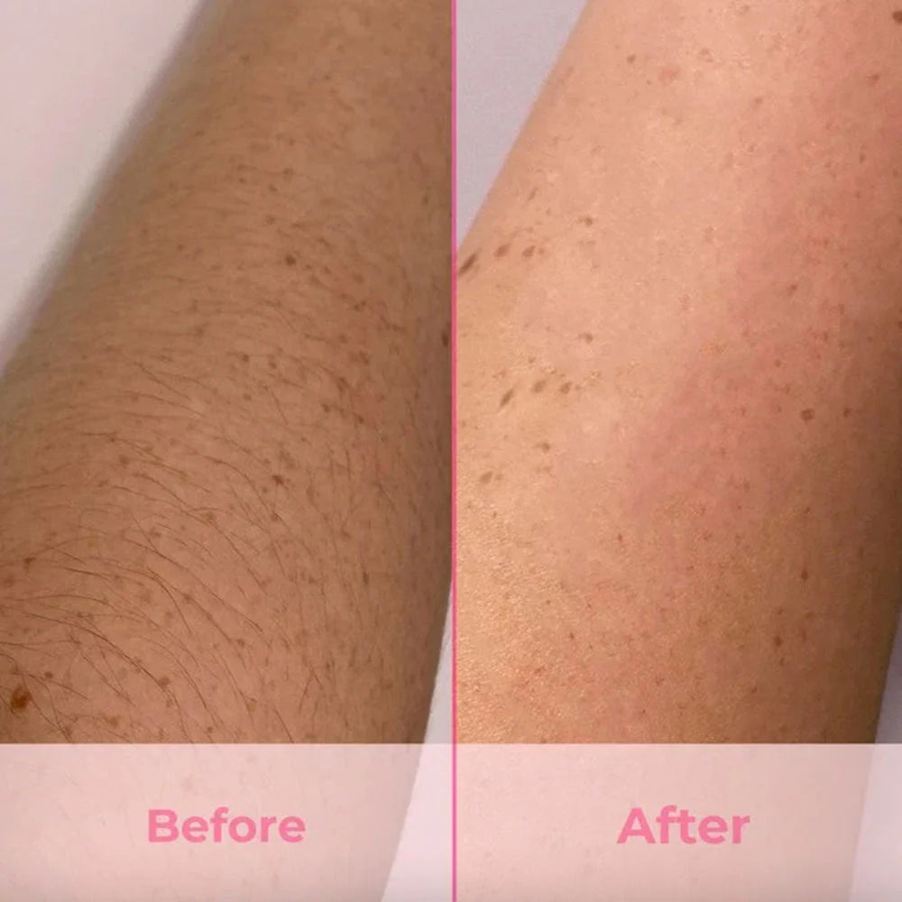 Laser Hair Removal - Active Cooling