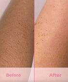 Laser Hair Removal - Active Cooling