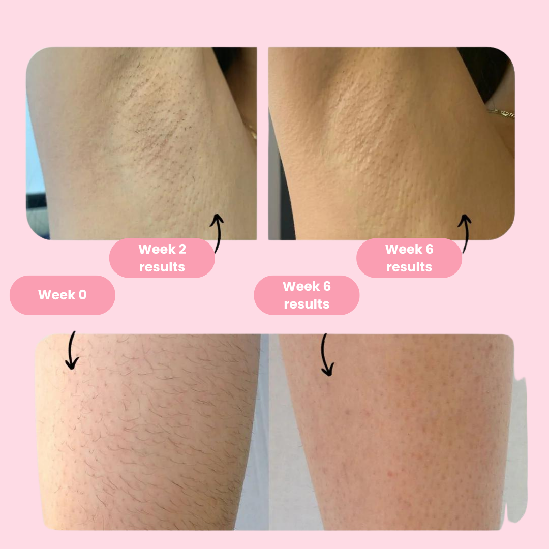 Laser Hair Removal Machine PRO