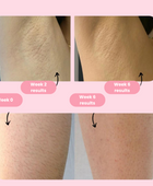 Laser Hair Removal Machine PRO